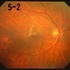 intraretinal hemorrhage and retinal exudation